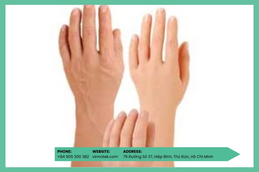 Chân tay giả thẩm mỹ
