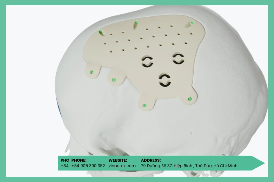 Implant PEEK gia công