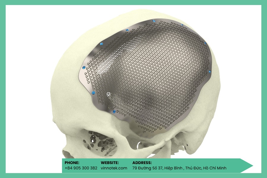 Implant hộp sọ tùy chỉnh: độ chính xác hình học là then chốt