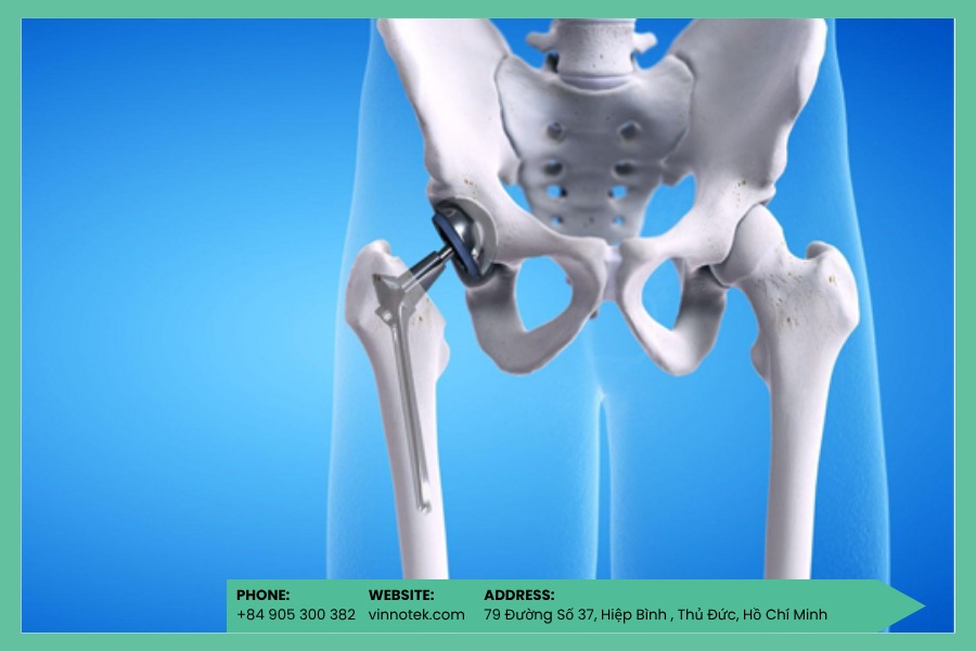 Implant khớp háng tùy chỉnh (acetabular cup) cho ca revision phức tạp