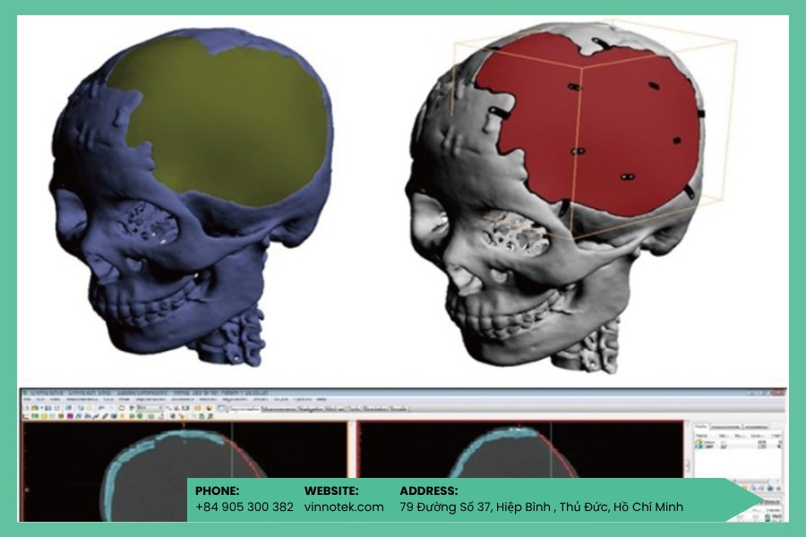 Implant tùy chỉnh: khớp chuẩn theo CT/MRI, tối ưu kết quả phẫu thuật.