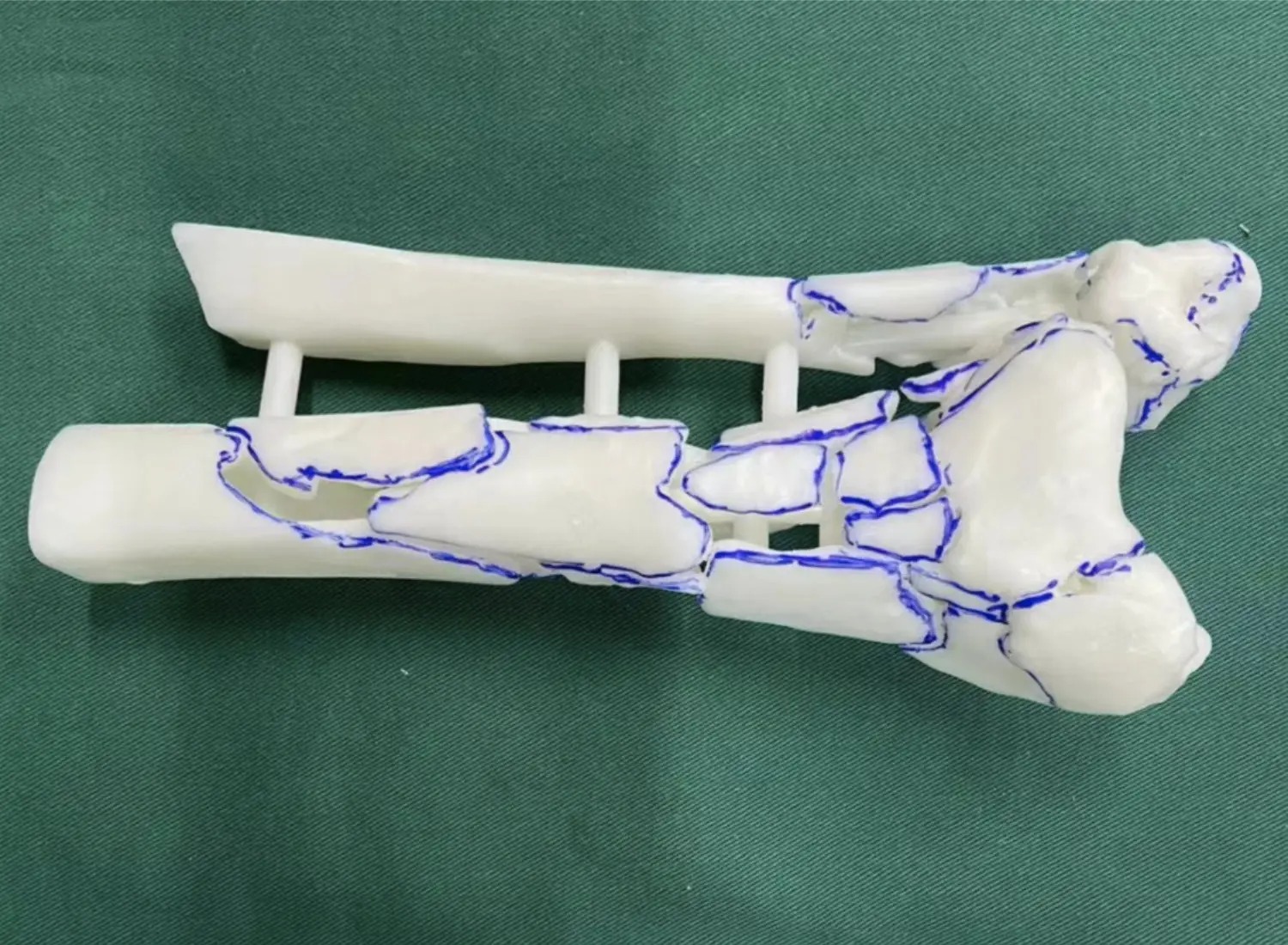 Mô Hình Xương Và Khớp - Lập Kế Hoạch Implant Chỉnh Hình