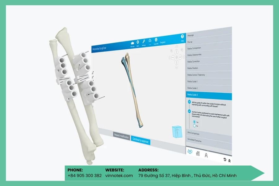 Pedicle Screw Guide 3D định vị vít cột sống chính xác, giảm rủi ro tối đa