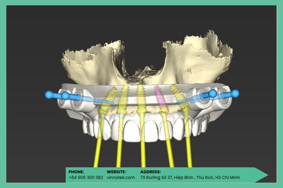 Surgical guide in 3D là thiết bị y tế tùy chỉnh được in 3D từ dữ liệu CT/CBCT