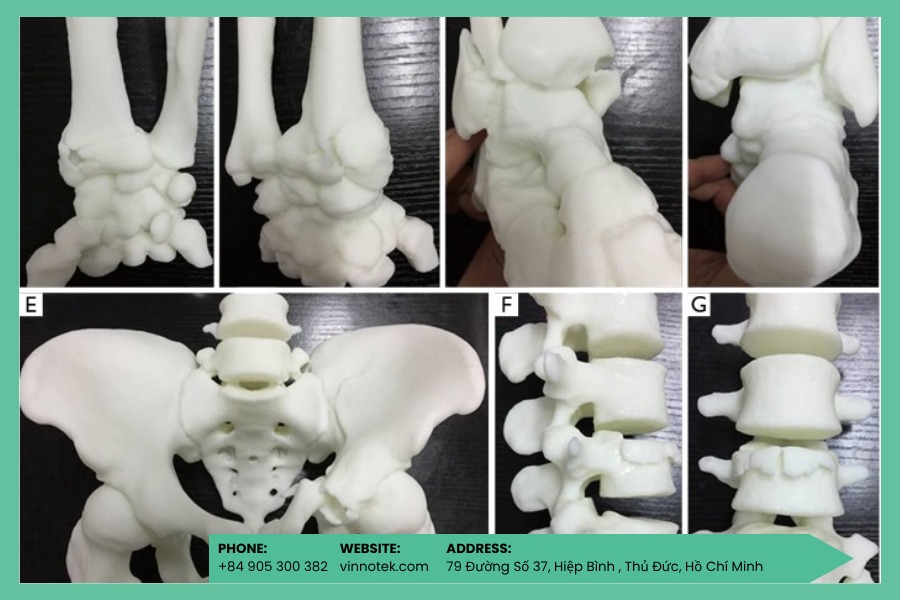 Mô hình giải phẫu 3D giúp lập kế hoạch chính xác cho gãy xương phức tạp