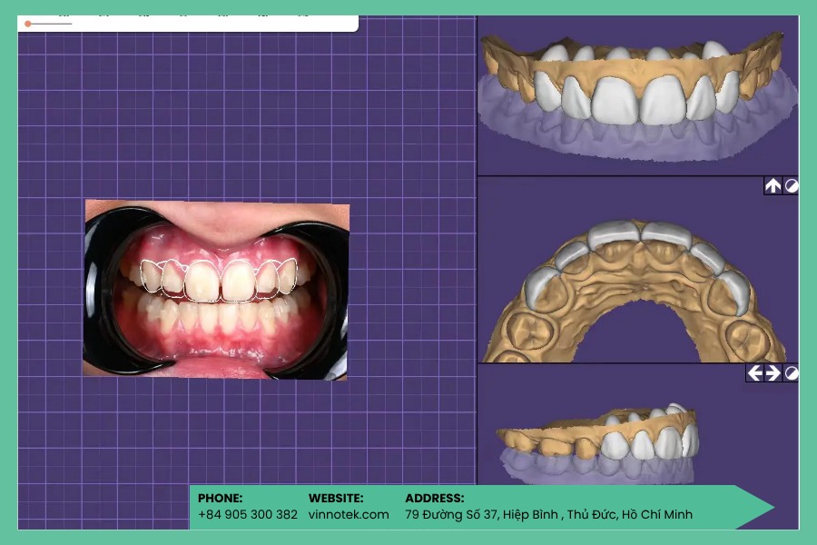 Workflow in 3D rút ngắn thời gian sản xuất dental casting